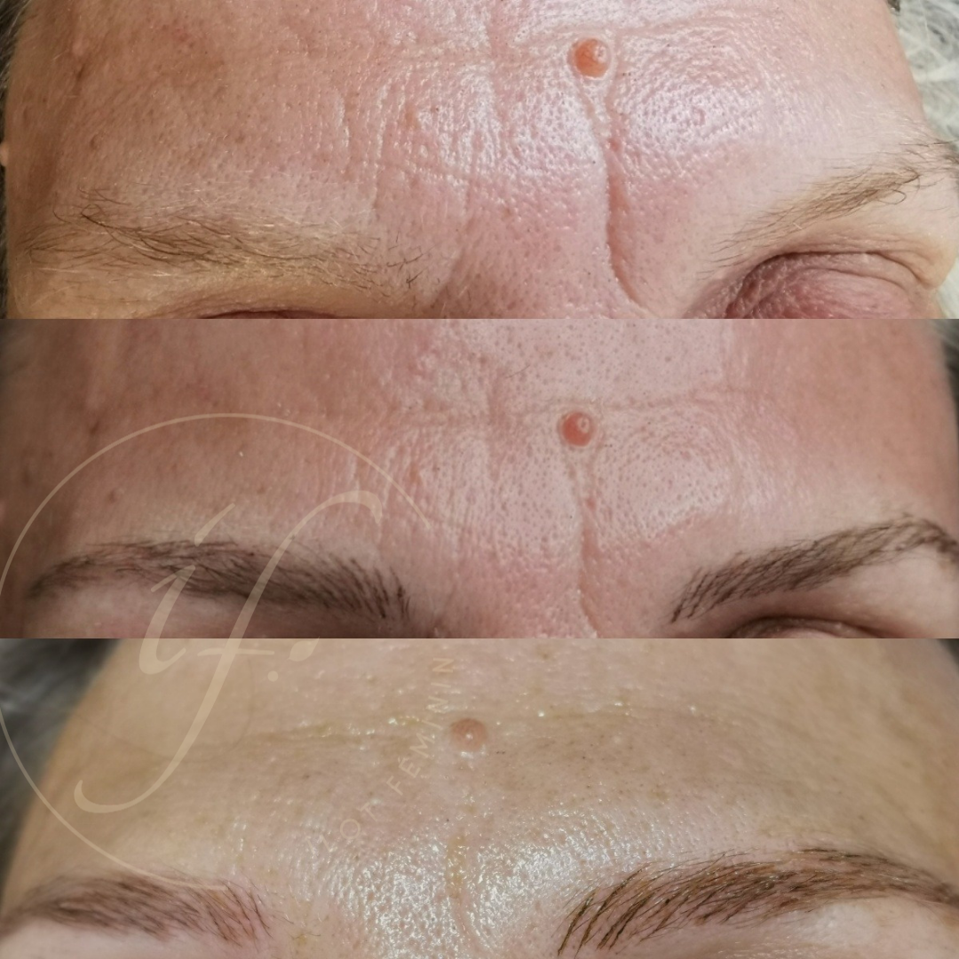 fils de collagene front rajeunissement3